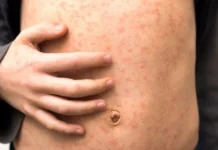 North London Measles Outbreak Infects Dozens of Children Across Schools Medical staff prepare measles vaccination doses as health authorities respond to rising outbreak cases among school children in north London communities